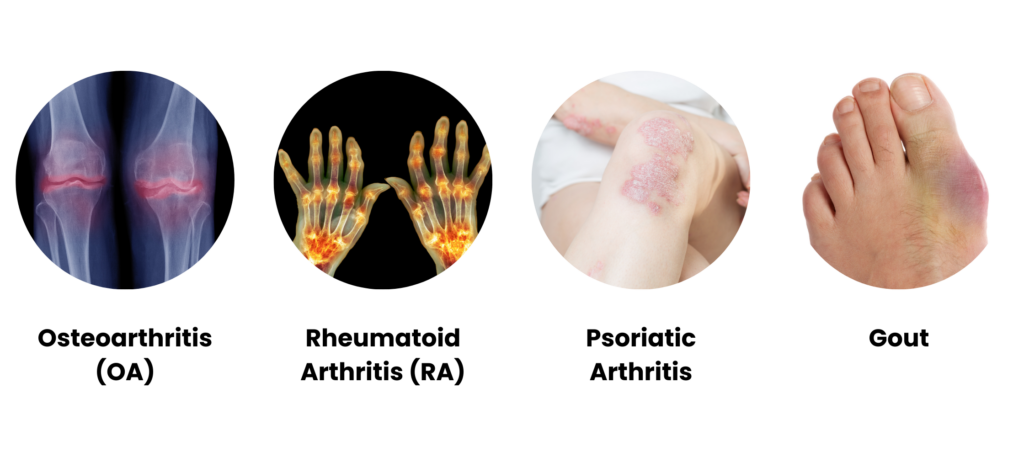 Common Type of Arthritis by All Heart Care Agency